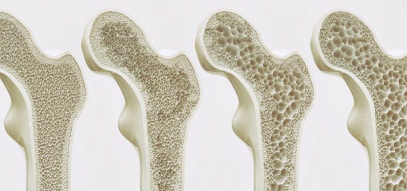Οστεοπόρωση